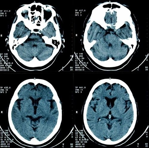 Suspect Alzheimer’s? Tips and tests for detection